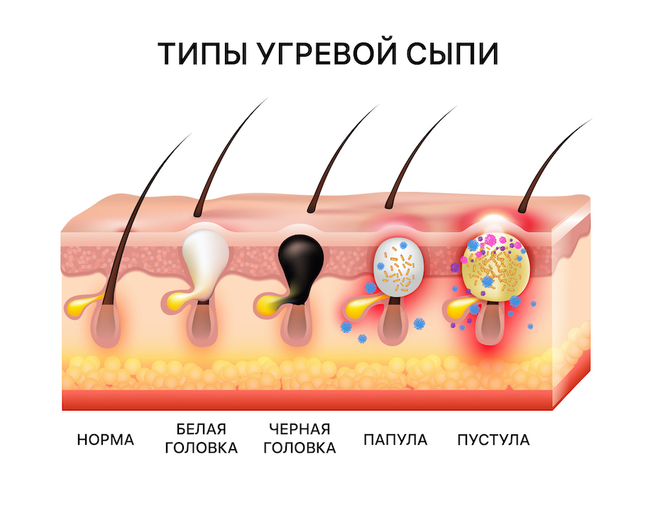 типы угревой сыпи папула пустула акне рисунок ветеринарная клиника доктора ярошенко